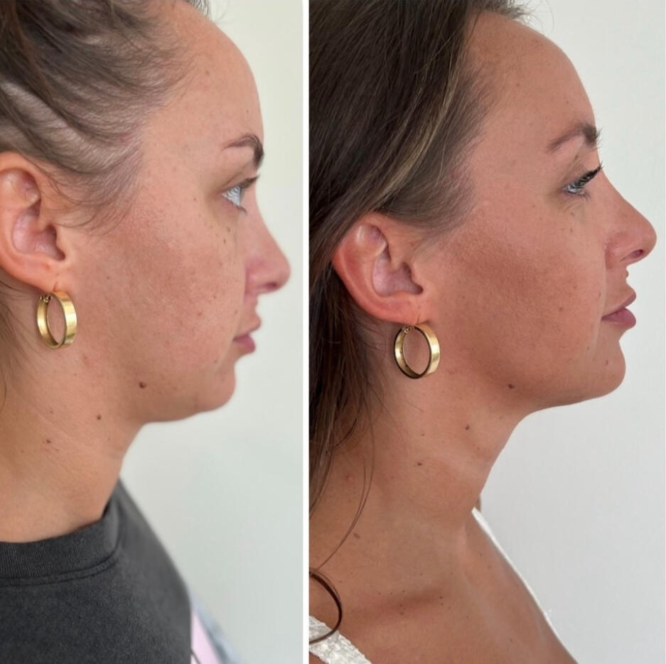 Meso Therapy &quot;Double Chin&quot;