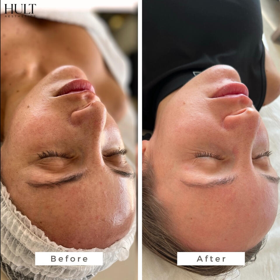 Microneedling