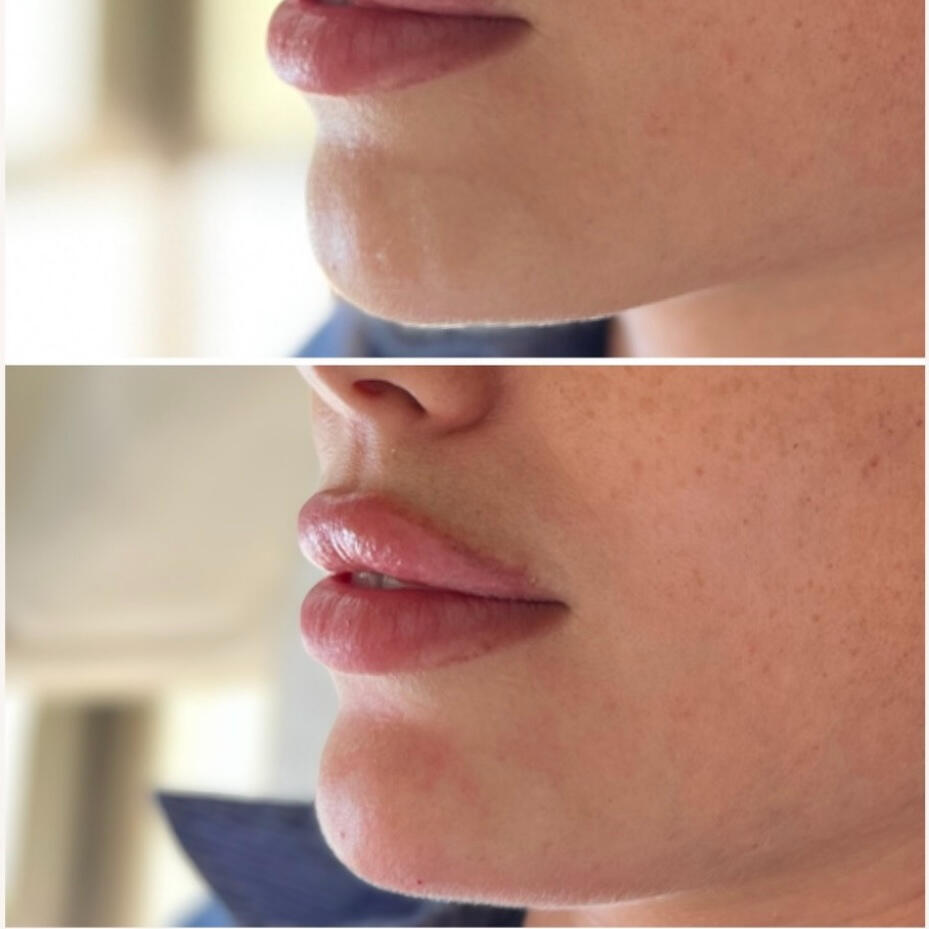 Chin Filler