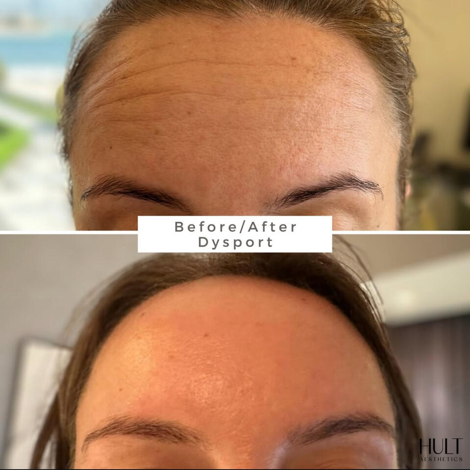 Botox Treatment