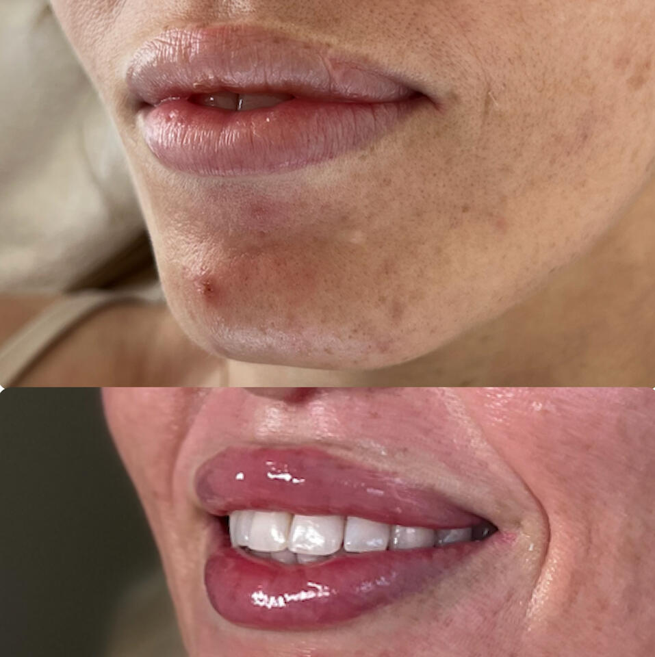 Lip Filler
